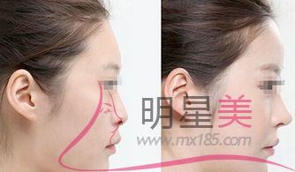 打<a href=http://www.f3bb6.cn/listinfo-731-0.html target=_blank class=infotextkey>玻尿酸</a>什么用