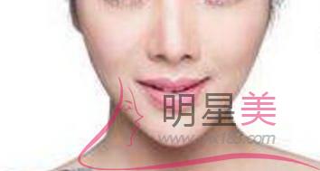 自體脂肪<a href=http://www.f3bb6.cn/listinfo-643-0.html target=_blank class=infotextkey>豐額頭</a>恢復期多久