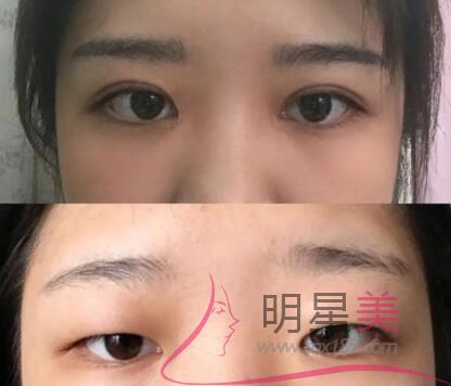 假體豐下巴風險大不大