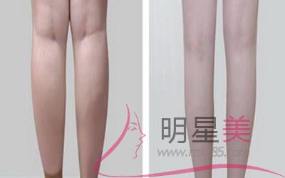 大腿內側長出疤痕