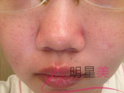 下巴后縮嘴巴前凸怎么辦