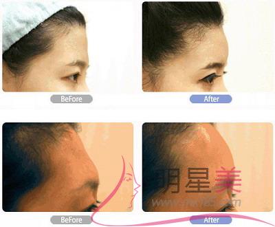 額頭<a href=http://www.f3bb6.cn/listinfo-754-0.html target=_blank class=infotextkey>鼻翼</a>兩側下巴長痘痘什么原因啊