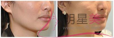 怎么額頭上皺紋