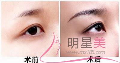 紋眉會得傳染病嗎