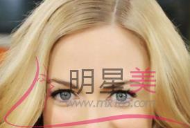 <a href=http://www.f3bb6.cn/listinfo-690-0.html target=_blank class=infotextkey>自體脂肪填充</a>額頭腫脹期多久