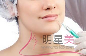 自體脂肪填下巴優缺點