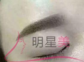 紋眉屬于手術嗎