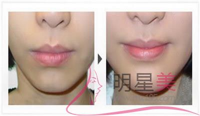 淮安面部美容去皺