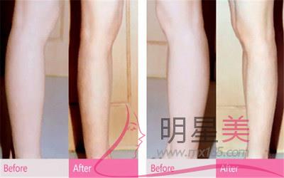 抽小腿脂肪的多少錢