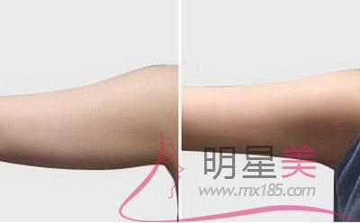 手臂粗怎么瘦下來動作