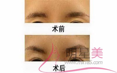 撫州<a href=http://www.f3bb6.cn/listinfo-652-0.html target=_blank class=infotextkey>眉毛種植</a>毛種植