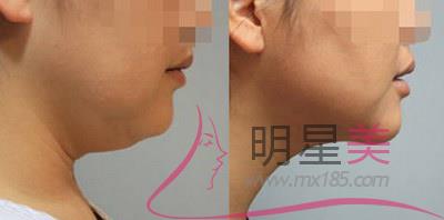 激素臉修復要多久