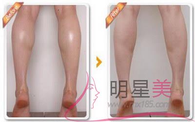 抽腿部脂肪對身體有害嗎