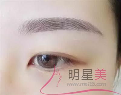 種植眉毛后的效果圖