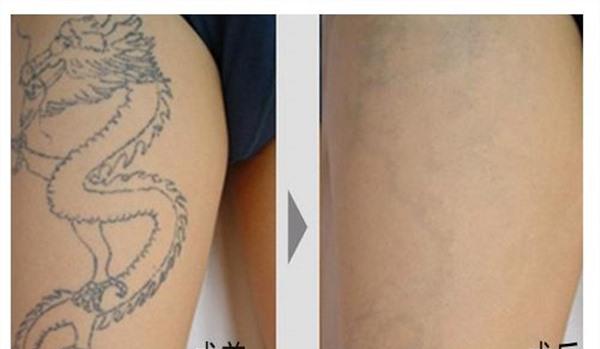 做皮膚磨削去紋身價(jià)格大概需要多少