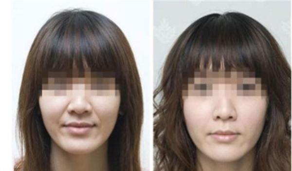 做<a href=http://www.f3bb6.cn/listinfo-792-0.html target=_blank class=infotextkey>去法令紋</a>不適應人群有哪些