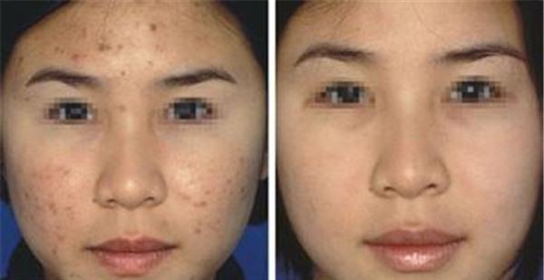 做膠原蛋白填充<a href=http://www.f3bb6.cn/listinfo-797-0.html target=_blank class=infotextkey>去痘疤</a>副作用是什么