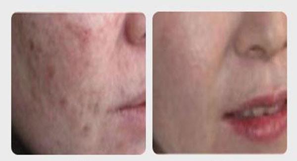 做<a href=http://www.f3bb6.cn/listinfo-734-0.html target=_blank class=infotextkey>愛貝芙</a><a href=http://www.f3bb6.cn/listinfo-797-0.html target=_blank class=infotextkey>去痘疤</a>價格貴嗎