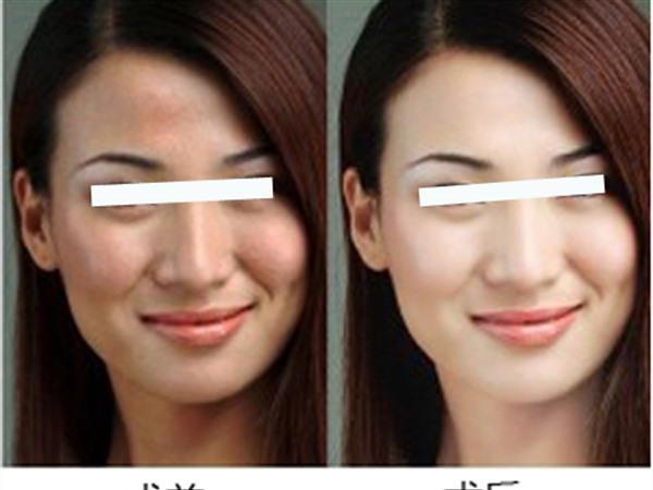 E光美白維持時間是多久？