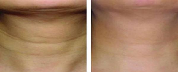 做自體脂肪除頸紋費用大概需要多少