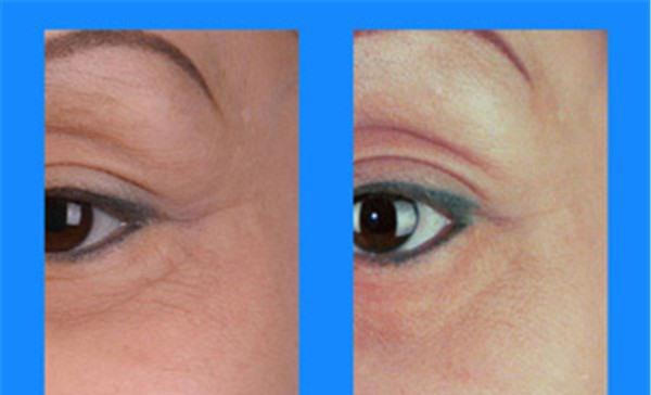 做果酸換膚<a href=http://www.f3bb6.cn/listinfo-782-0.html target=_blank class=infotextkey>去眼角細紋</a>價格