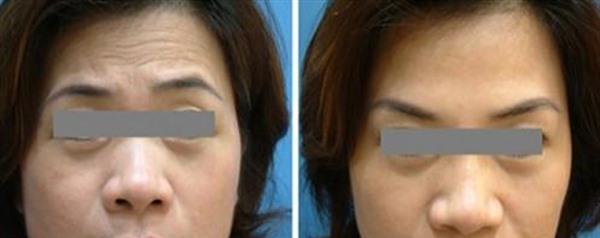 E光除抬頭紋手術注意事項是什么？