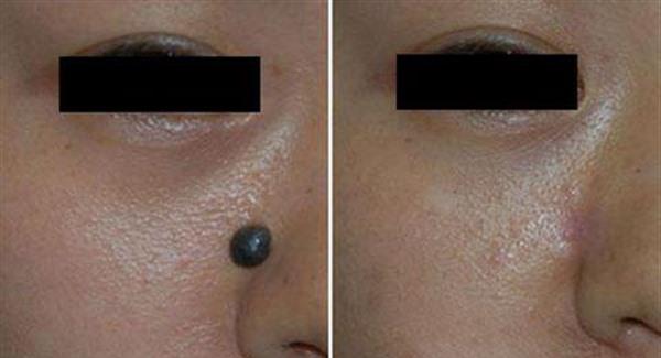 做剝脫治療<a href=http://www.f3bb6.cn/listinfo-774-0.html target=_blank class=infotextkey>去雀斑</a>手術多少錢？