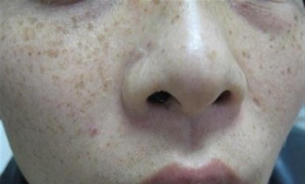 <a href=http://www.f3bb6.cn/listinfo-786-0.html target=_blank class=infotextkey>去黃褐斑</a>的妙招