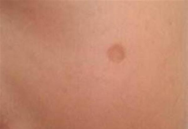 點痣后留疤了怎么辦