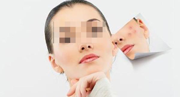 針清祛痘需要多少錢