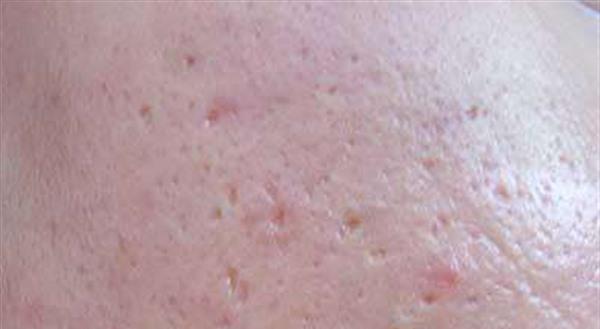 祛痘坑激光多少錢啊