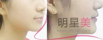 抽脂<a href=http://www.f3bb6.cn/listinfo-630-0.html target=_blank class=infotextkey>豐太陽穴</a>多久才能側(cè)著睡