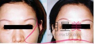 抽脂<a href=http://www.f3bb6.cn/listinfo-630-0.html target=_blank class=infotextkey>豐太陽穴</a>安全嗎