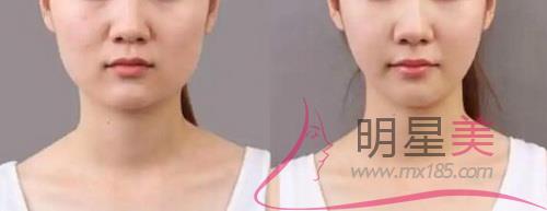 武漢墊下巴哪里好