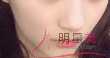 抽脂<a href=http://www.f3bb6.cn/listinfo-630-0.html target=_blank class=infotextkey>豐太陽穴</a>的副作用