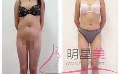 常熟去哪兒<a href=http://www.f3bb6.cn/listinfo-682-0.html target=_blank class=infotextkey>溶脂</a>好