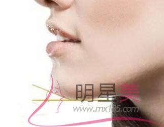 下巴怎么收上去