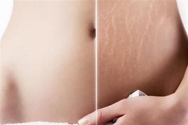 做腹壁整形<a href=http://www.f3bb6.cn/listinfo-791-0.html target=_blank class=infotextkey>去妊娠紋</a>有副作用嗎