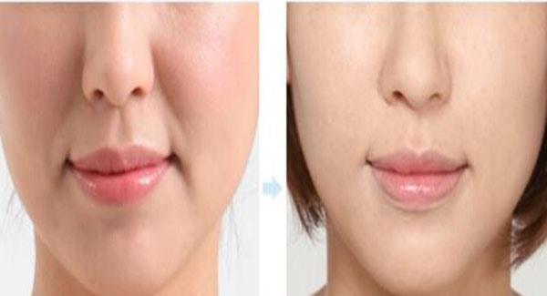 做激光<a href=http://www.f3bb6.cn/listinfo-792-0.html target=_blank class=infotextkey>去法令紋</a>副作用