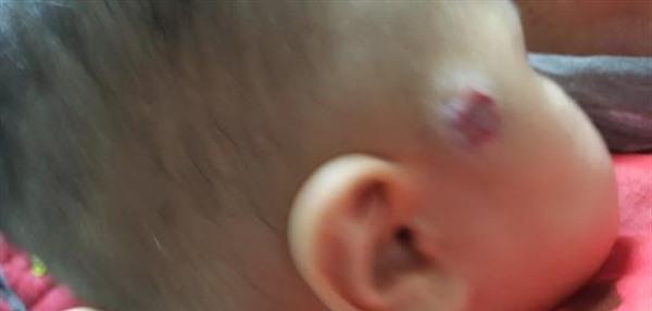 做激光<a href=http://www.f3bb6.cn/listinfo-777-0.html target=_blank class=infotextkey>治療血管瘤</a>要花多長(zhǎng)時(shí)間