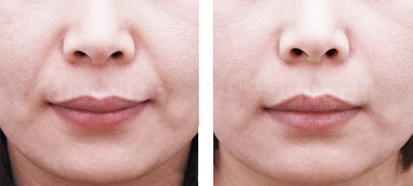 E光<a href=http://www.f3bb6.cn/listinfo-792-0.html target=_blank class=infotextkey>去法令紋</a>麻醉方式是什么？