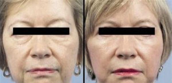 做<a href=http://www.f3bb6.cn/listinfo-613-0.html target=_blank class=infotextkey>射頻</a><a href=http://www.f3bb6.cn/listinfo-768-0.html target=_blank class=infotextkey>微針</a><a href=http://www.f3bb6.cn/listinfo-771-0.html target=_blank class=infotextkey>去眉間紋</a>風險有哪些