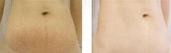 做激光<a href=http://www.f3bb6.cn/listinfo-791-0.html target=_blank class=infotextkey>去妊娠紋</a>費用大概需要多少