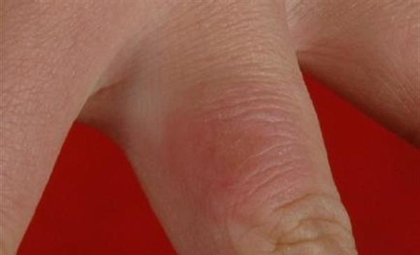 凍瘡疤痕修復手術安全嗎？