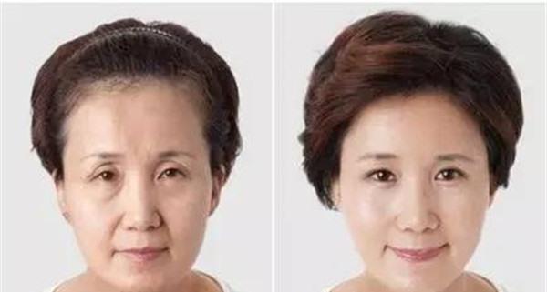 光子<a href=http://www.f3bb6.cn/listinfo-792-0.html target=_blank class=infotextkey>去法令紋</a>不適合哪種人?