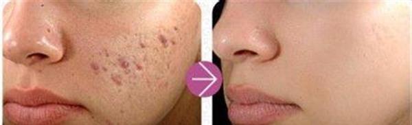 做脈沖光去痘印手術(shù)多少錢(qián)？