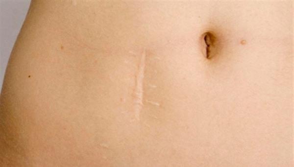 醫院<a href=http://www.f3bb6.cn/listinfo-783-0.html target=_blank class=infotextkey>祛疤</a>多少錢