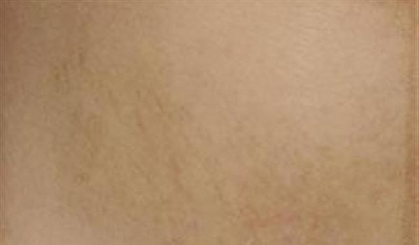 妊娠紋怎么消除