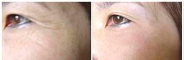 做<a href=http://www.f3bb6.cn/listinfo-780-0.html target=_blank class=infotextkey>去魚尾紋</a>失敗修復有副作用嗎