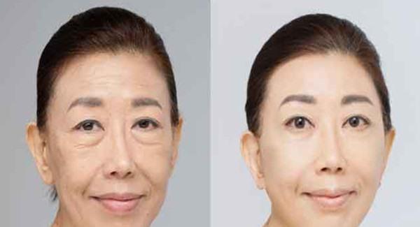 做激光<a href=http://www.f3bb6.cn/listinfo-792-0.html target=_blank class=infotextkey>去法令紋</a>有副作用嗎